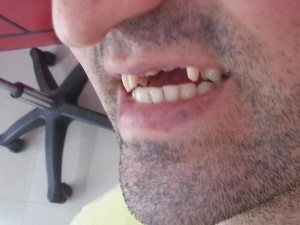 Dental Crowns & Bridge Case